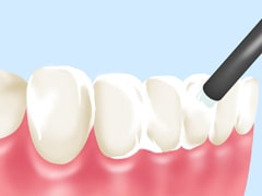フッ素塗布（自費治療）