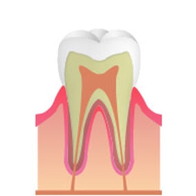 C0　初期の虫歯