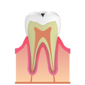 C1 エナメル質内の虫歯