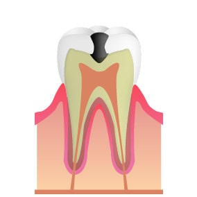 C2 象牙質に達した虫歯