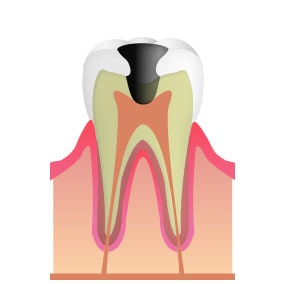 C3 神経 (歯髄)に達した虫歯