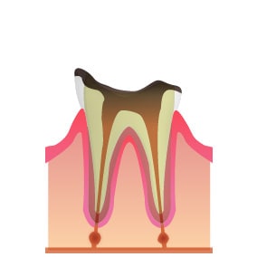 C4 歯根まで達した虫歯
