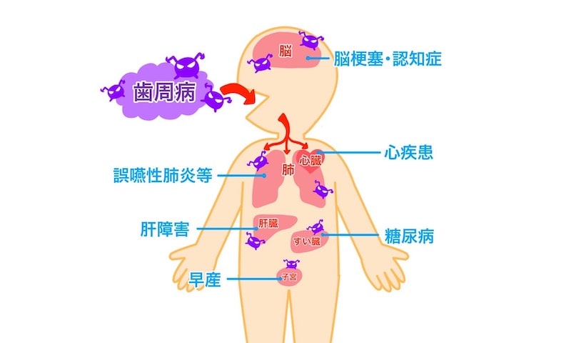 歯周病と全身疾患との関係