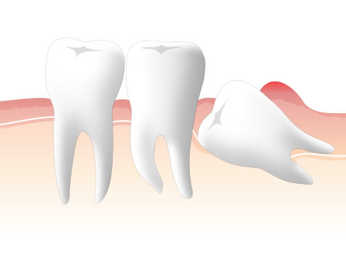 親知らずを抜歯する基準
